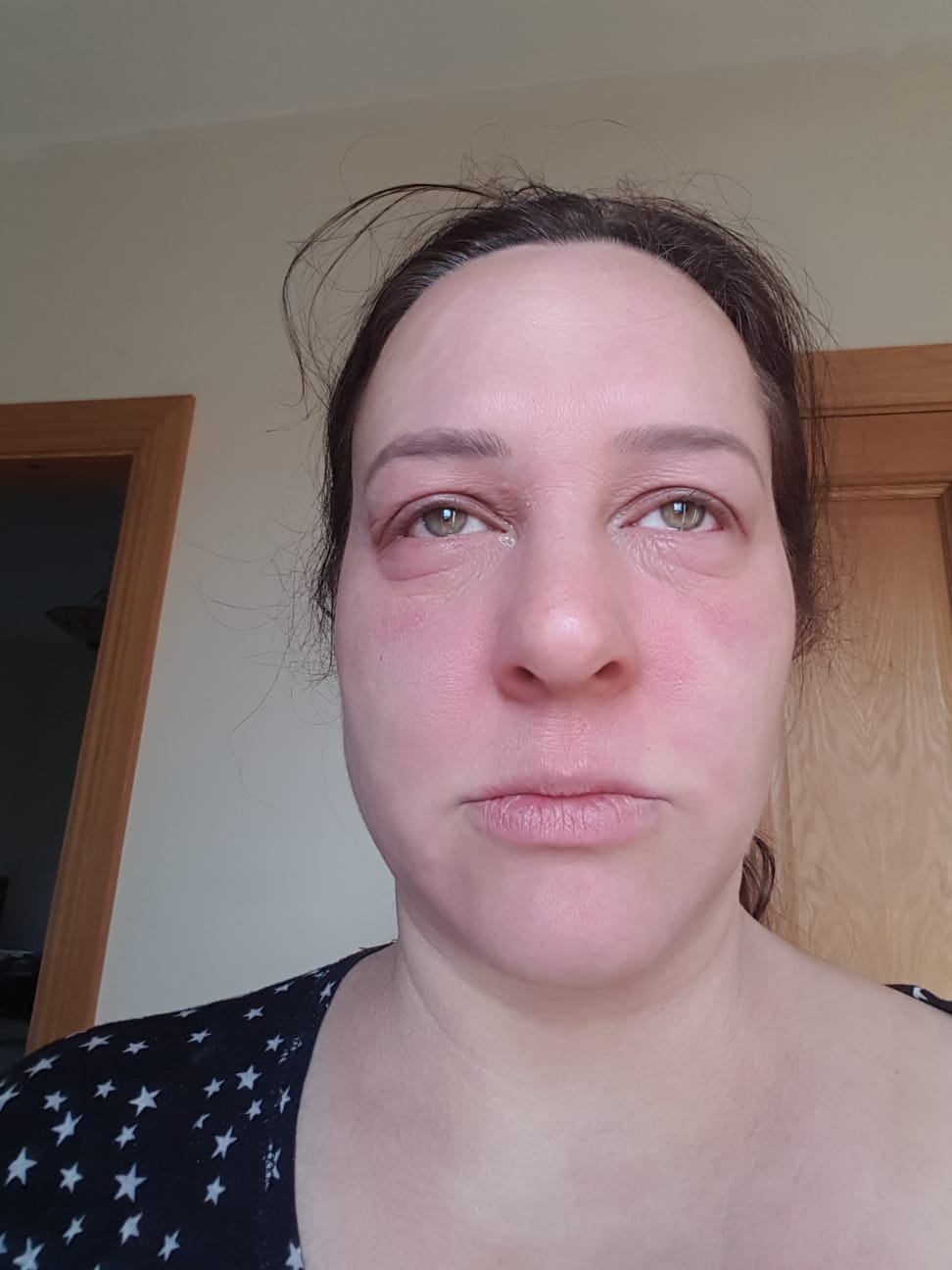 Conversations with… Natasha (Subject: Adult Eczema, Topical Steroid Withdrawal and Confidence)